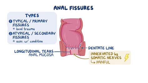 anaal limburg|Anale Fissuur